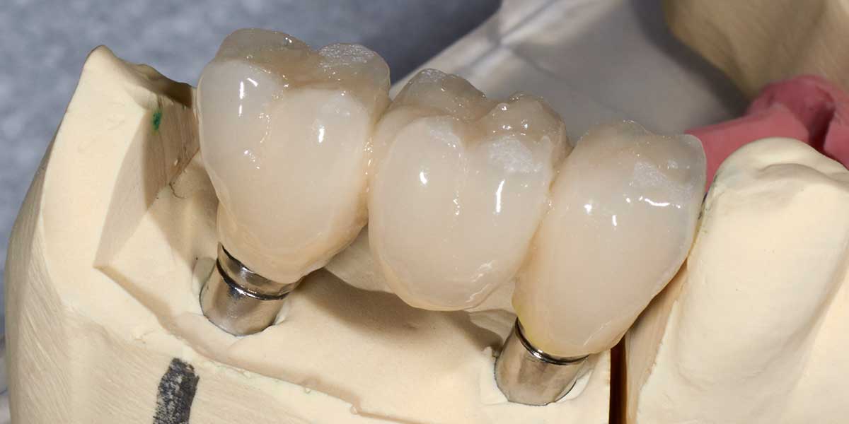 Dental Implant Supported Bridges