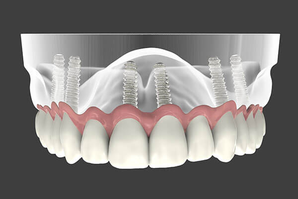 Implant Supported Dentures in Morgan Hill