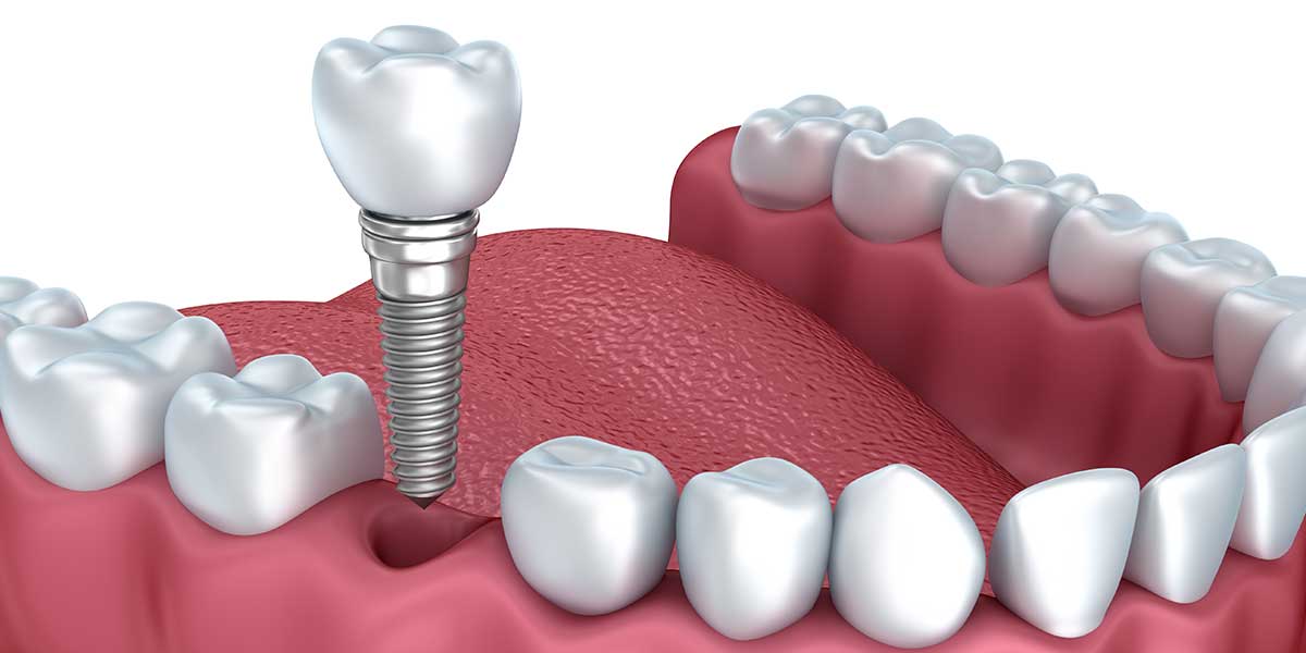 Single Dental Implants in Morgan Hill