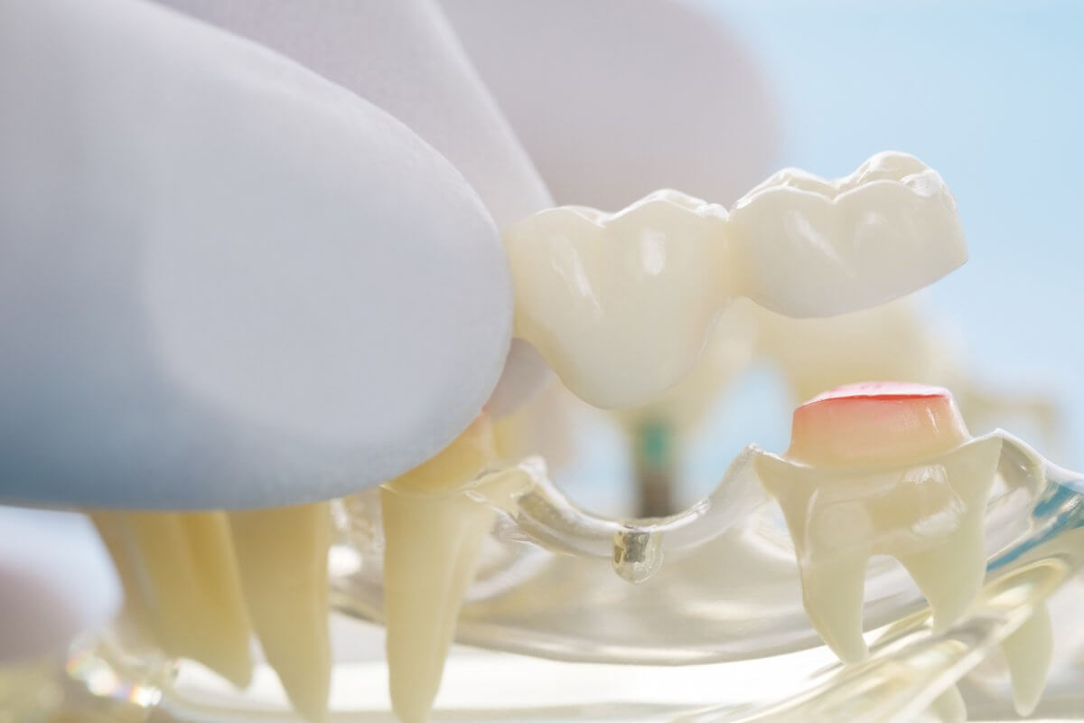 Model Of Dental Bridge