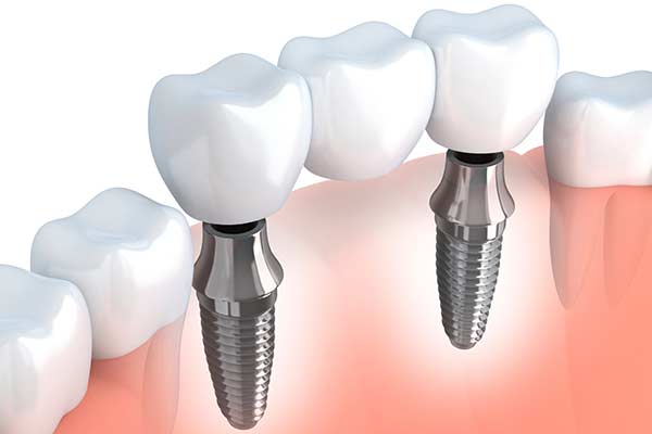 Implant Supported Bridges in Morgan Hill