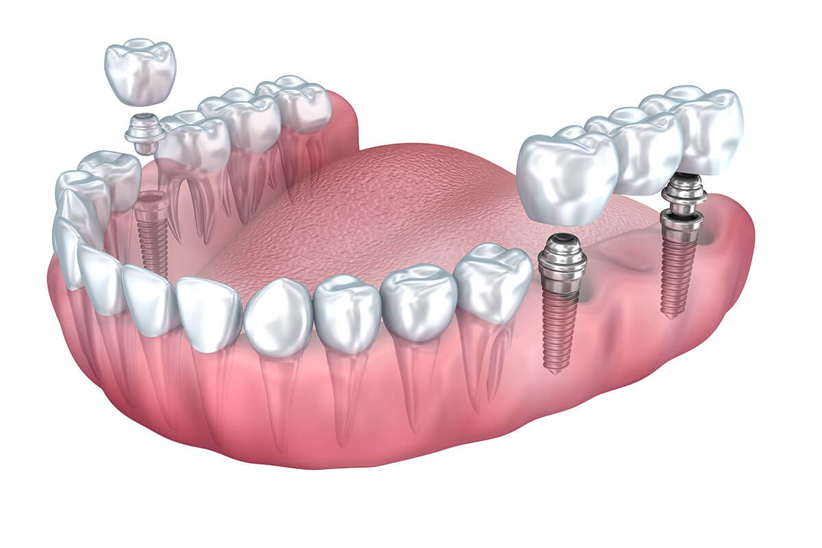 Dental Implants vs Bridge: Consider Your Options | Dr. McDonald