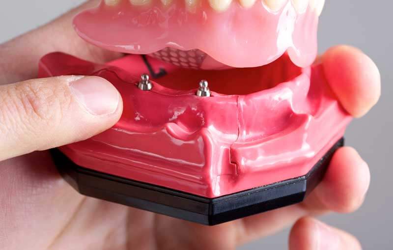 Mini Dental Implants in Morgan Hill
