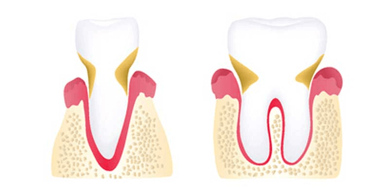 Moderate Periodontitis